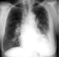 mesothelioma lung cancer