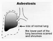 Asbestosis Lung