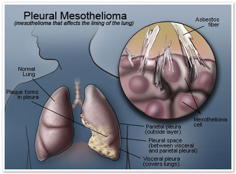 Pleural Mesothelioma Asbestos Lung Cancer